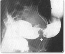 大腸がんの注腸造影検査 S状結腸がん